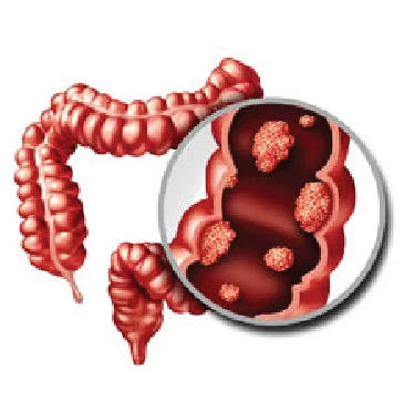 Things to Know About Colon Cancer and its Treatment